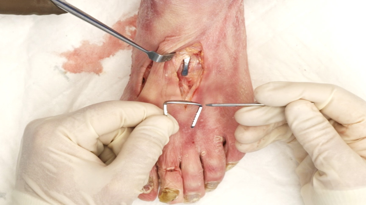 TMT-Fusion-with-REFLEX-Nitinol-Staple
