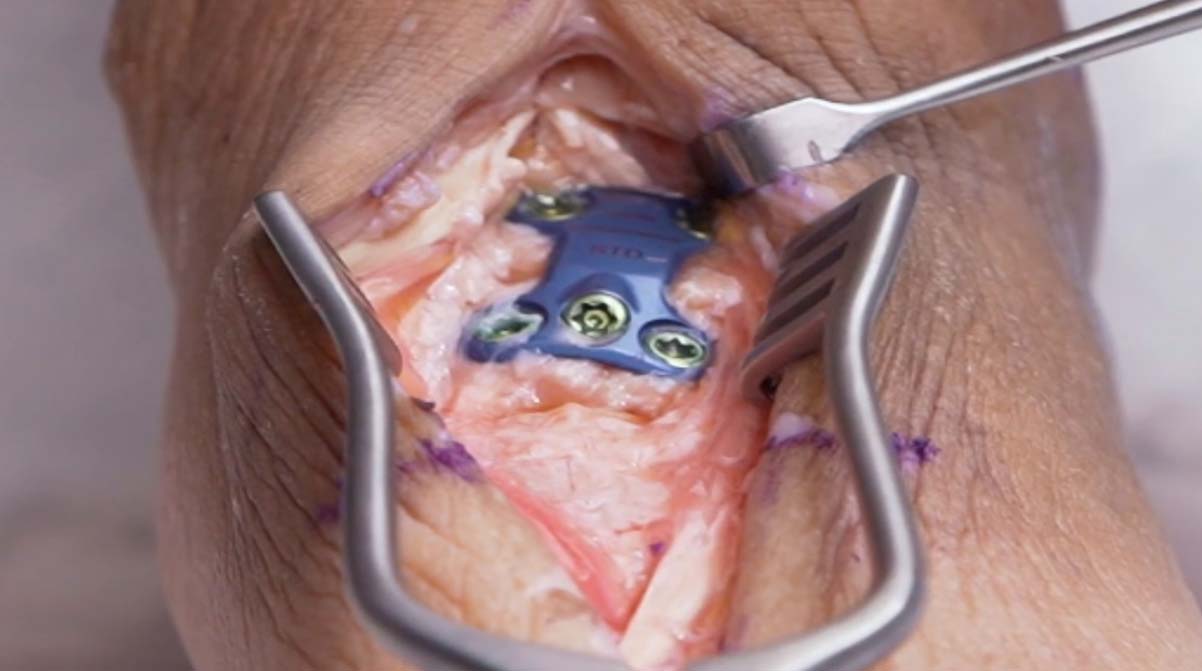 TN-Fusion-Cadaveric-Demo