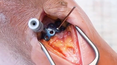 Tarsal-Specific-Fracture-Plating-Demo-1