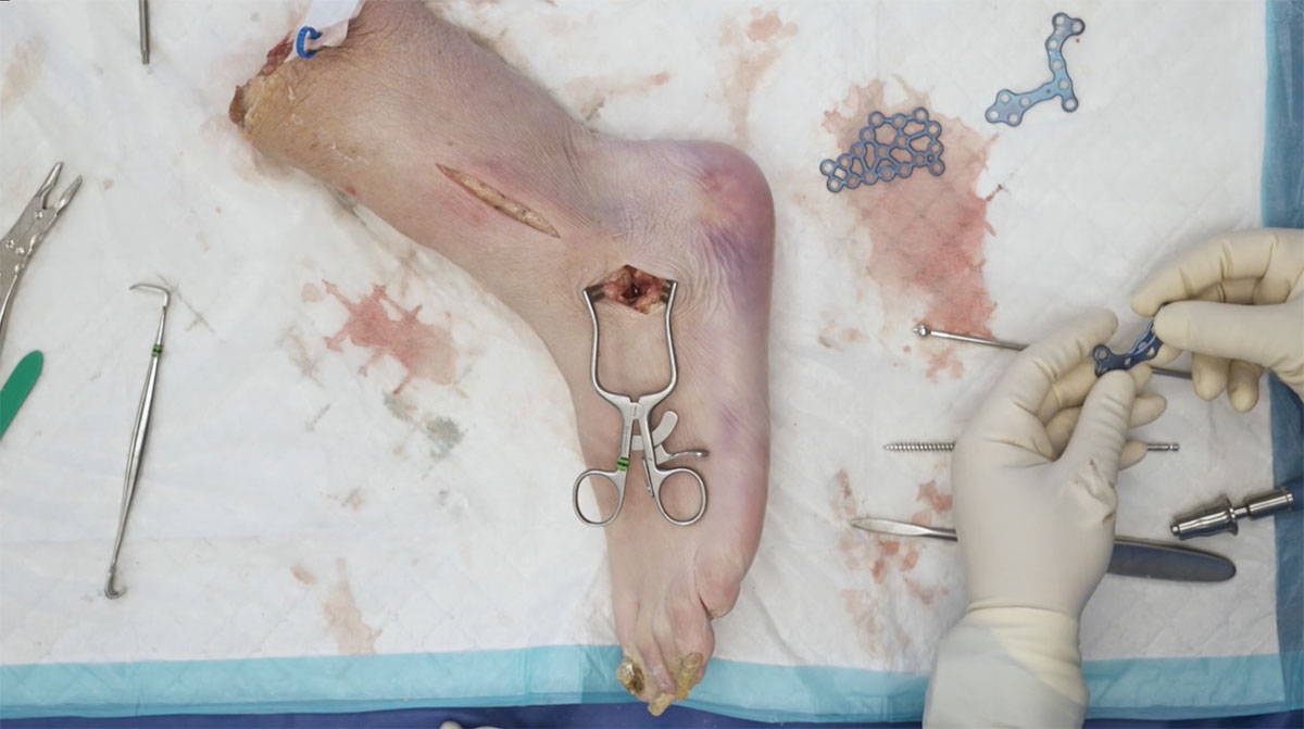 calcaneal-fracture-plating-system-overview