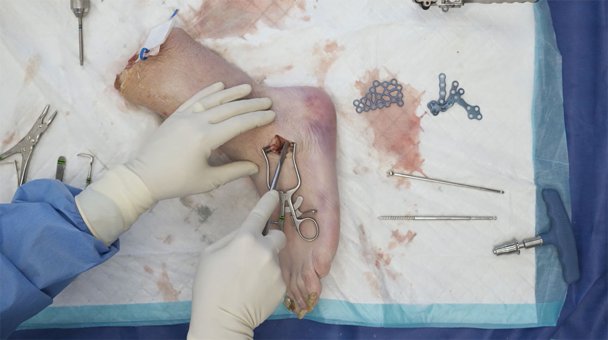 calcaneal-fracture-sinus-tarsi-approach
