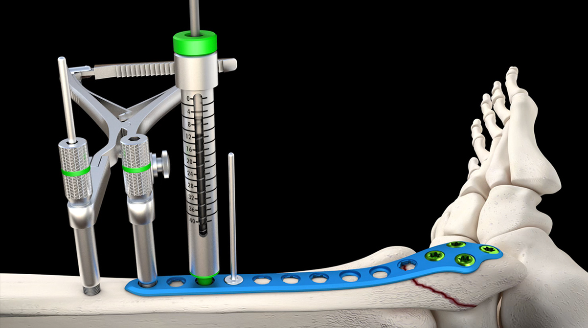 fibula-1