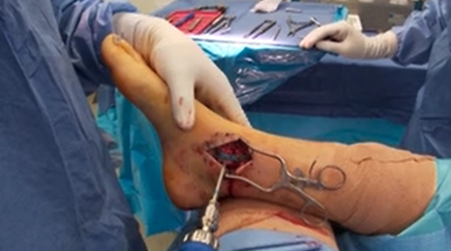 medial-meg-plate