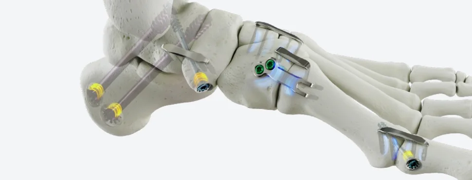 nitinol_implant_system_hero_bnr_img