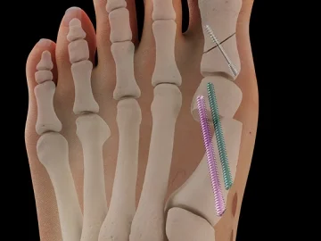 MIS_Foot_Recon_System_thumbnail