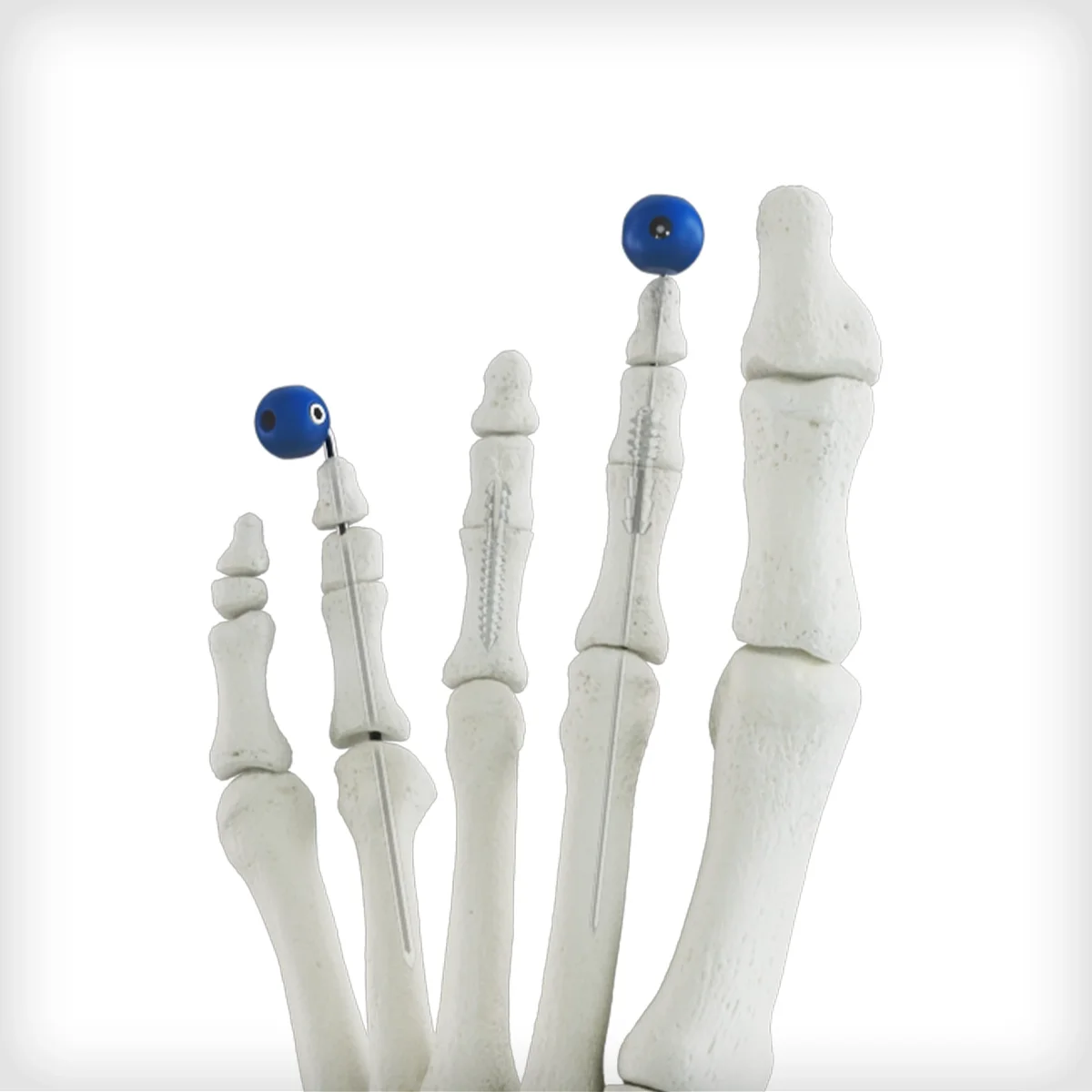 REFLEX® Hammertoe Implant System