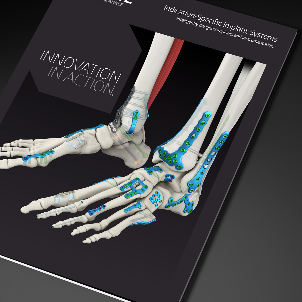 Core Foot Recon Plating System - Unite Foot and Ankle